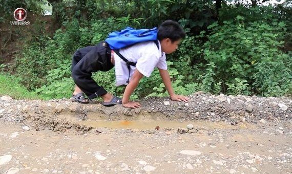 선척적 무릎 과신전 기형 질병