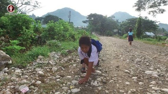 선척적 무릎 과신전 기형 질병