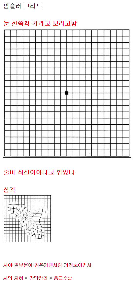 [기타] 방치하면 실명할 수 있는 눈 이상 증상.