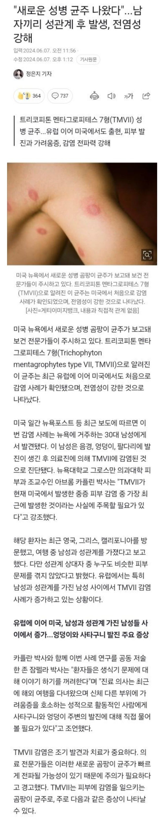 새로운 동성애 성병, TMVII