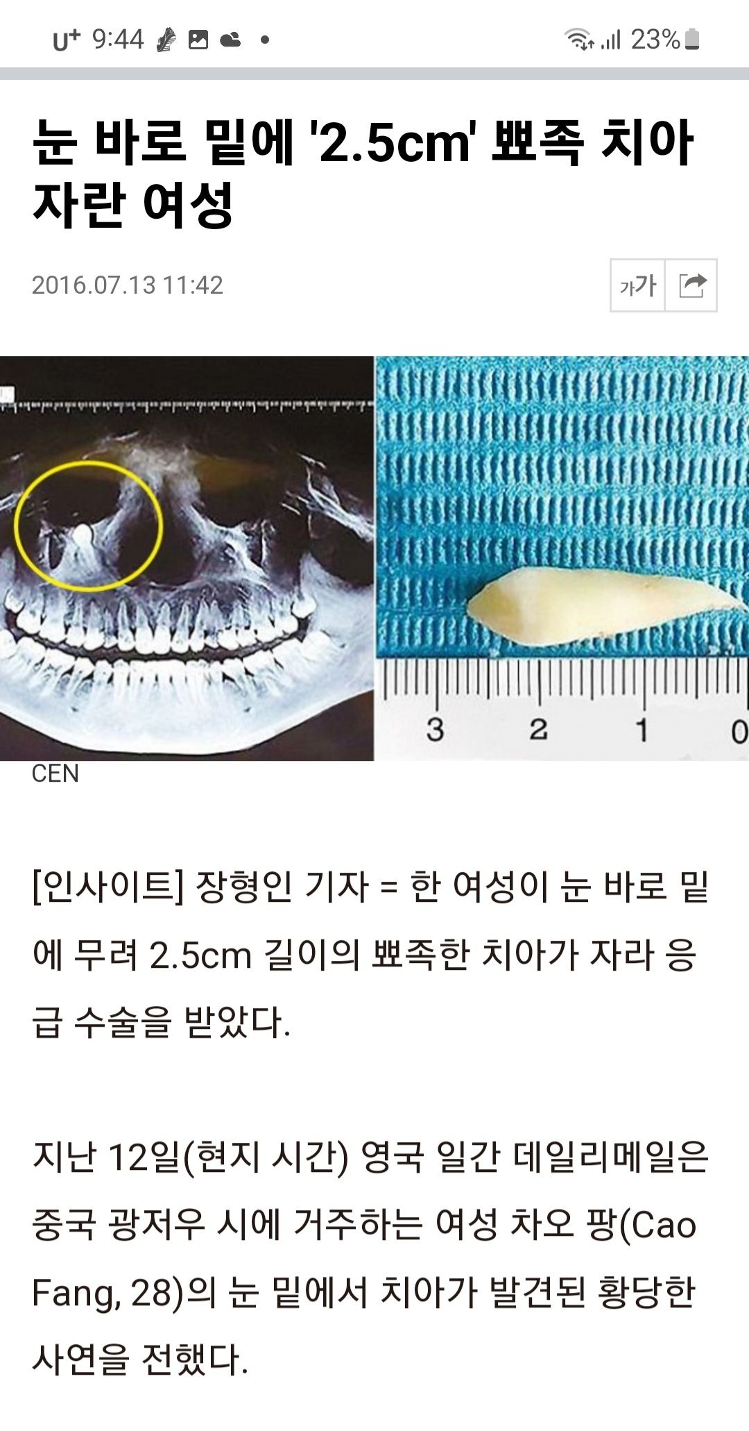 3층 사랑니 눈에 과잉치