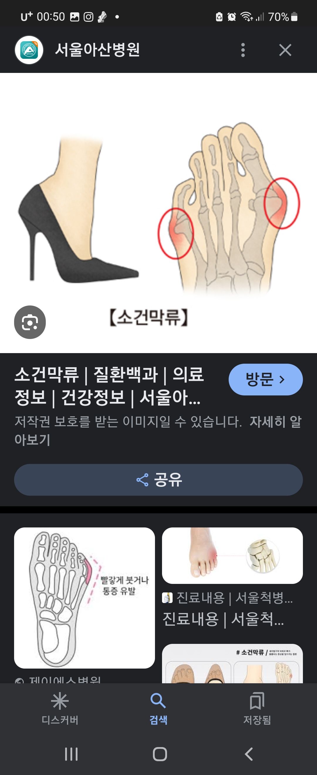 하이힐 신으면 생기는 발 질병