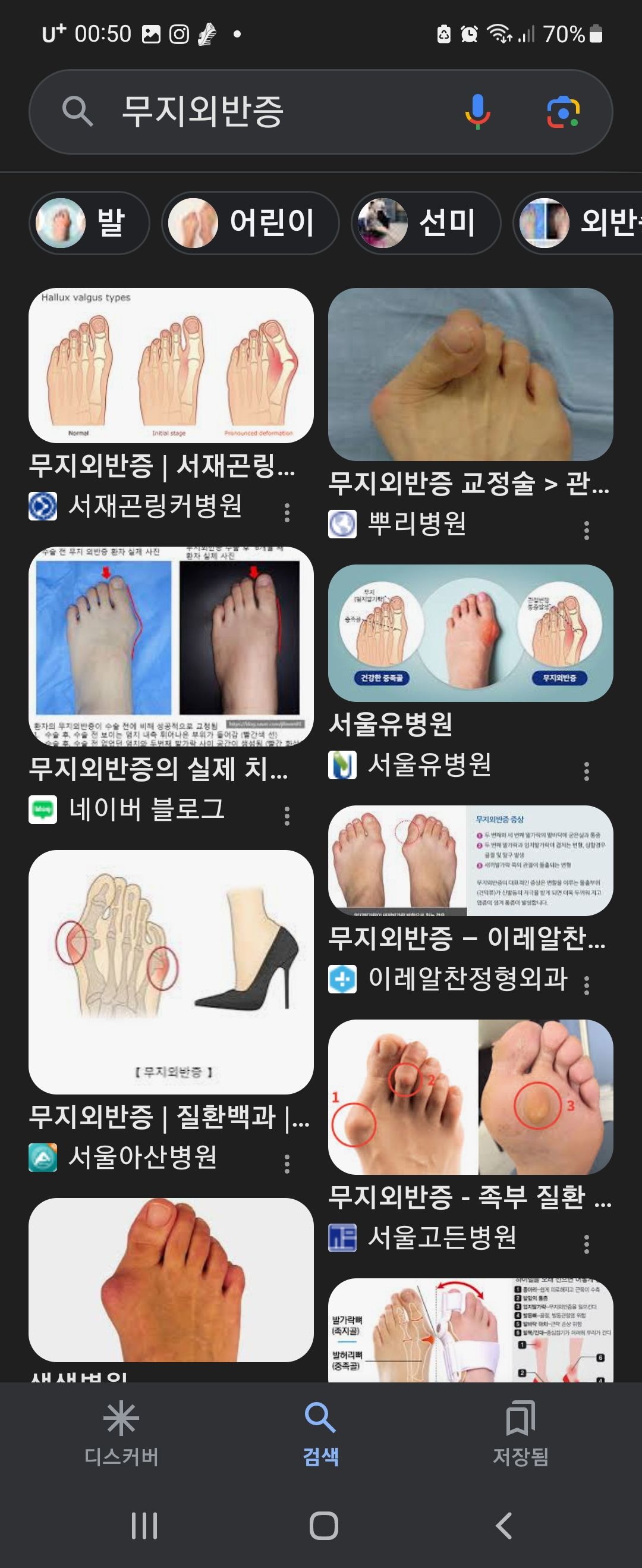 하이힐 신으면 생기는 발 질병