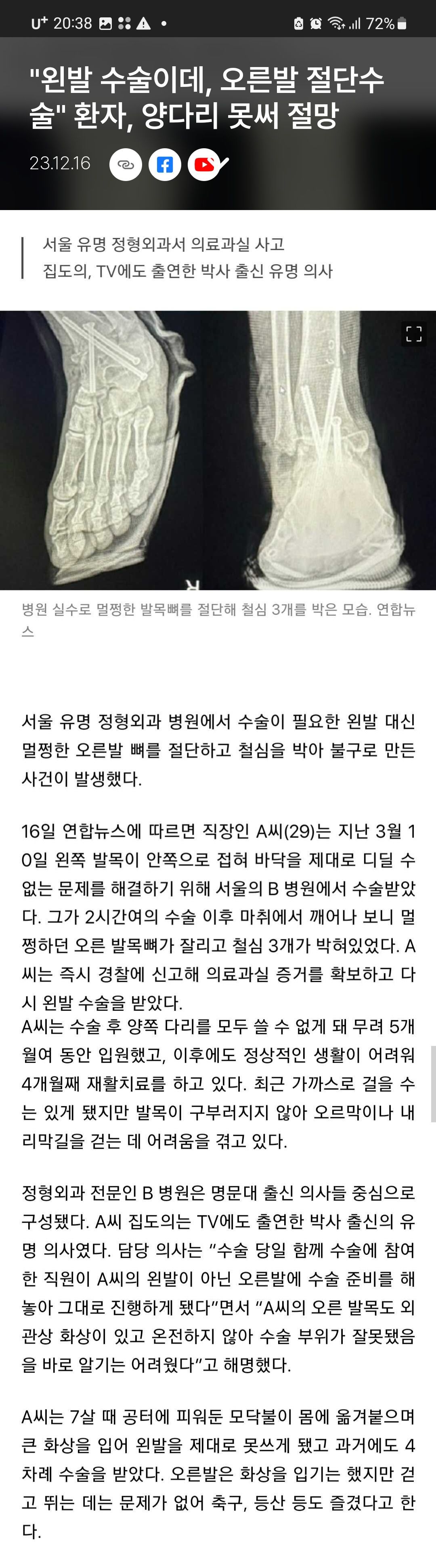 서울 의사 착각하고 멀쩡한 다리 절단 양쪽다 불구 됨