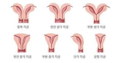 두개의 자궁에서 두 아이를 출산한 미국인